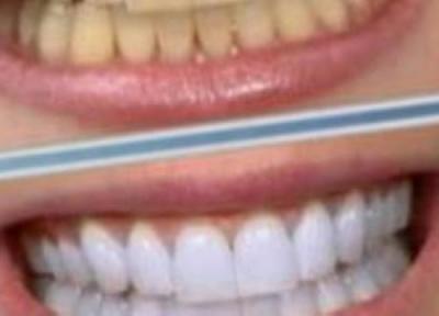 دانستنی های سفیدکردن دندان