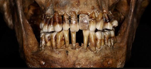 روش عجیب نگه داشتن دندان ها به وسیله این زن ثروتمند قرن هفدهمی! ، رنج هایی که آن دالگر در زندگی کشید